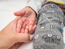 Mengenal Flu Singapura: Ini Gejala, Penyebab, dan Cara Pengobatannya