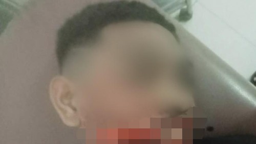 Korban pembacokan di Alor luka parah di wajah.