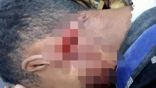 RA, korban pembacokan di Kecamatan Alor Tengah Utara, Kabupaten Alor, NTT. (Dok Polres Alor).