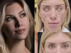 Tragis! Ratu Kecantikan Ini Tak Bisa Tutup Mata Setelah Operasi Plastik Gagal