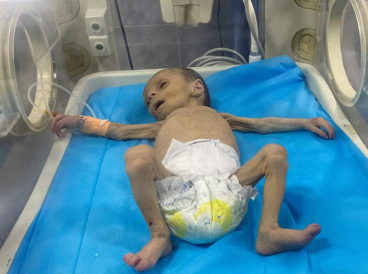 Potret Pilu Balita Palestina Berjuang Lawan Malnutrisi di Gaza