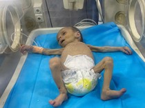 Potret Pilu Balita Palestina Berjuang Lawan Malnutrisi di Gaza