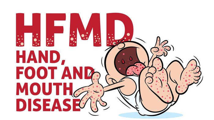 Salah Kaprah Flu Singapura, Bukan Flu dan Bukan Asli Singapura