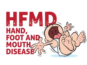 Salah Kaprah Flu Singapura, Bukan Flu dan Bukan Asli Singapura
