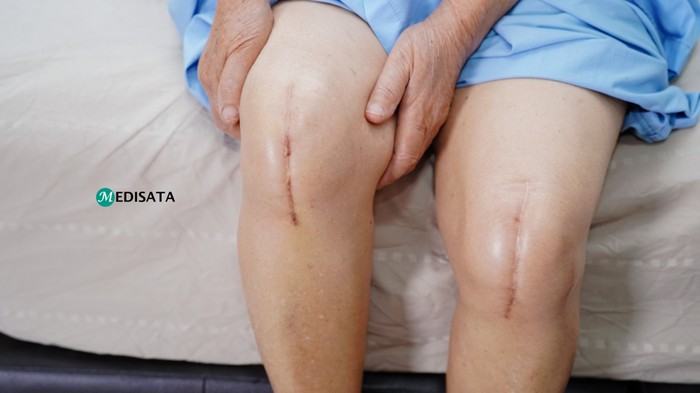 Medisata Perkenalkan Operasi Ganti Lutut dengan Bantuan Robot