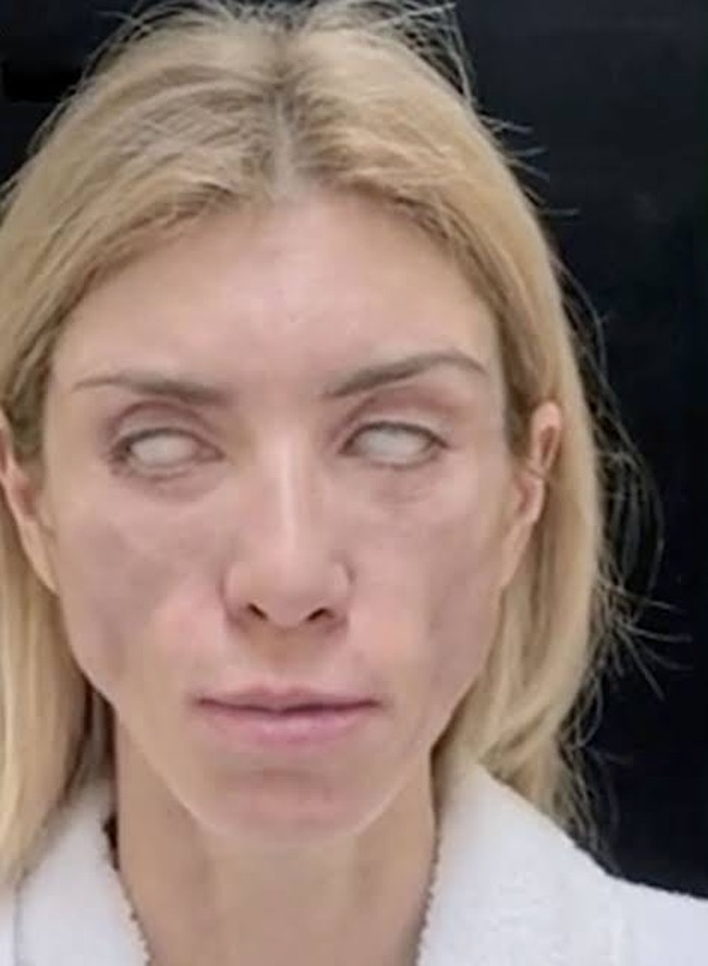 Operasi tersebut mengakibatkan Yulia tidak hanya kehilangan kemampuan untuk tersenyum, tetapi juga tidak dapat menutup mata. Setelah menjalani operasi pertama yang gagal, Yulia mencoba mencari bantuan di klinik lain untuk memperbaiki kesalahan tersebut, namun upaya tersebut juga berakhir dengan kegagalan.  Foto: Dok. Instagram, YouTube