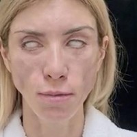 Operasi tersebut mengakibatkan Yulia tidak hanya kehilangan kemampuan untuk tersenyum, tetapi juga tidak dapat menutup mata. Setelah menjalani operasi pertama yang gagal, Yulia mencoba mencari bantuan di klinik lain untuk memperbaiki kesalahan tersebut, namun upaya tersebut juga berakhir dengan kegagalan.  Foto: Dok. Instagram, YouTube