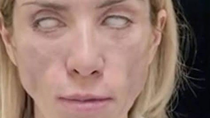 Nasib Ratu Kecantikan Rusia, Wajahnya Jadi Aneh gegara Oplas Gagal Total