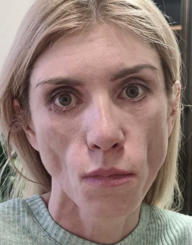 Wajahnya membengkak parah dan meradang, dengan pipi yang cekung dan mata yang lumpuh.  Foto: Dok. Instagram, YouTube