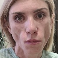 Wajahnya membengkak parah dan meradang, dengan pipi yang cekung dan mata yang lumpuh.  Foto: Dok. Instagram, YouTube