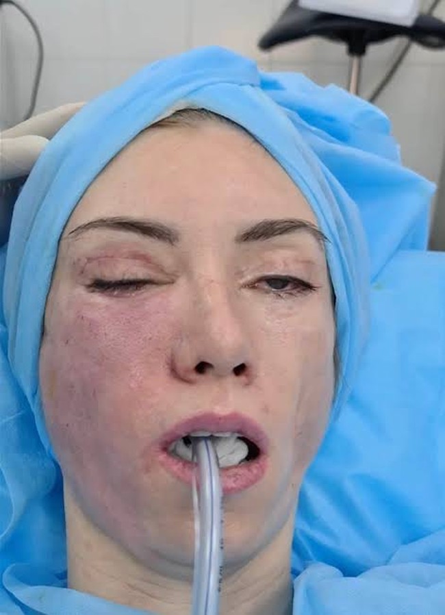 Ahli bedah plastik tersebut berkilah bahwa apa yang dialami Julia adalah kondisi genetik langka yang disebut skleroderma. Komrov bersikeras bahwa kondisinya tersebut bukan karena operasi plastik yang dijalaninya. Julia menuturkan bahwa sampai saat ini tidak ada permintaan maaf dari dokter tersebut kepadanya. Foto: Dok. Instagram, YouTube