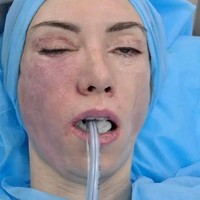 Ahli bedah plastik tersebut berkilah bahwa apa yang dialami Julia adalah kondisi genetik langka yang disebut skleroderma. Komrov bersikeras bahwa kondisinya tersebut bukan karena operasi plastik yang dijalaninya. Julia menuturkan bahwa sampai saat ini tidak ada permintaan maaf dari dokter tersebut kepadanya. Foto: Dok. Instagram, YouTube