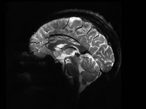 Peneliti Sebut Pandemi Covid Bikin Otak Remaja Perempuan Alami Penuaan Dini