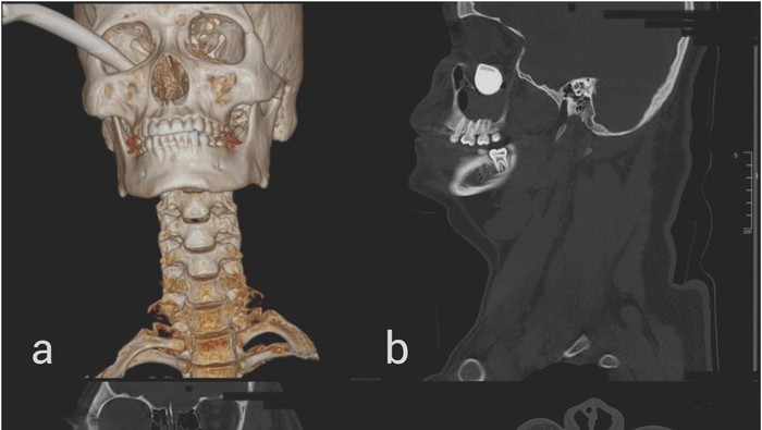 Ngeri! Ada Tuas Rem Motor Nyangkut di Mata Kanan Pria Ini gegara Kecelakaan
