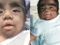 Viral Bocah 2 Tahun Idap Sindrom Manusia Serigala, Sekujur Tubuh Penuh Rambut