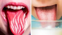 Susu memiliki lapisan yang membantu untuk meredakan rasa sakit secara instan. Celupkan lidah ke dalam susu dingin selama beberapa menit hingga rasa perih dan nyeri reda. Foto: Site/Brightside