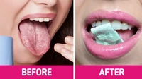 Mint di dalam permen karet cocok jadi obat instan untuk meredakan rasa sakit di lidah. Karena kandungan mint memberikan sensasi dingin di lidah. Foto: Site/Brightside