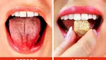 10 Cara Redakan Lidah yang Terbakar Setelah Santap Makanan Panas
