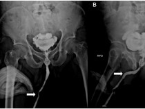 Momen Dokter Temukan Benda Asing di Mr P, Ada Sikat Gigi hingga Kabel Listrik