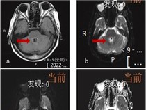 Ngeri! Wanita 77 Tahun Ini Tewas usai Terinfeksi Amoeba Pemakan Otak