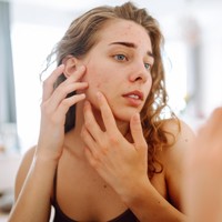 Apakah Bopeng Bisa Hilang dengan Skincare?