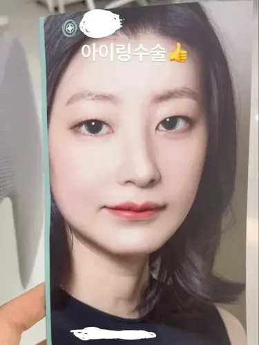Iklan operasi pembesaran pupil mata yang viral di Korea Selatan.