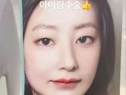 Tren Operasi Plastik Aneh di Korsel, Memperbesar Pupil Mata Secara Permanen