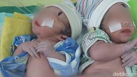 Viral Bayi Kembar Siam Langka di Tulungagung, Lahir dengan Bokong yang Menempel