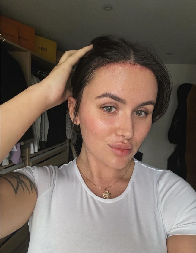 Setelah melepas jahitan, dahi Beth pun terlihat jauh lebih kecil. Perubahan pada penampilan membuatnya merasa seperti orang yang baru. Foto: Instagram/@hxlsey