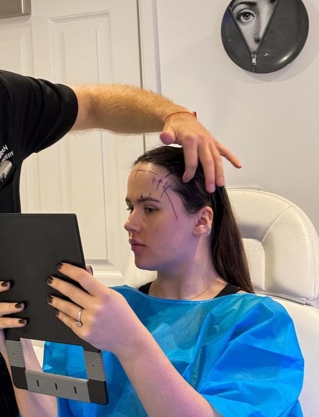 Langkah ekstrem diambil Beth dengan menjalani operasi pengecilan dahi. Menurutnya, operasi plastik adalah satu-satunya cara untuk mengatasi minder yang sudah bertahun-tahun dirasakannya karena terus-menerus diolok tentang ukuran dahinya. Foto: Instagram/@hxlsey