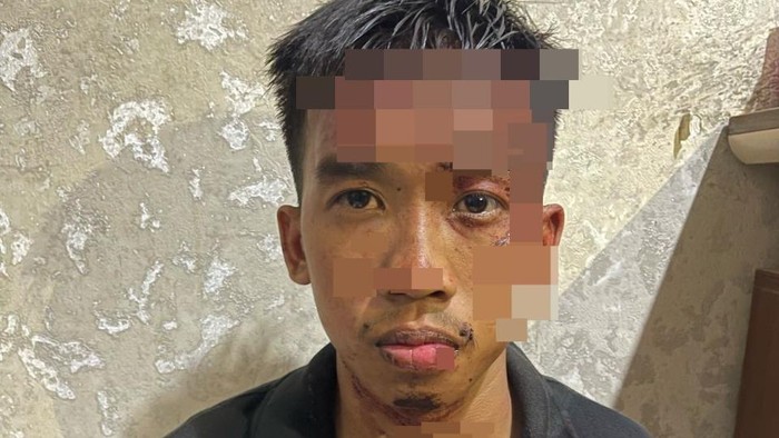 Wajah Akbar Subing babak belur dikeroyok oleh korban.