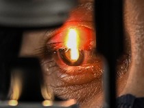 Pasien Katarak Jalani Operasi Gratis di RSUD Tamansari Jakbar