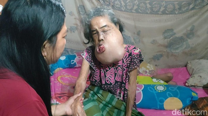 Sitti Nur (64) di Kabupaten Polewali Mandar (Polman), Sulbar mengidap tumor ganas dan butuh bantuan.
