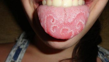 Geographic tongue. Foto: Martanopue via Bored Panda