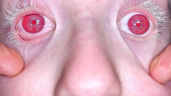 Albinisme mata. Kondisi ini mengurangi pewarnaan (pigmentasi) pada iris, yaitu bagian berwarna pada mata, dan retina yang merupakan jaringan peka cahaya di bagian belakang mata. Pigmentasi pada mata sangat penting untuk penglihatan normal. Foto: optometry case via Bored Panda