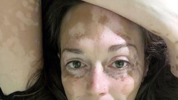 Vitiligo membuat kulitnya memiliki bercak dengan warna berbeda. Foto: pip_squeak3 via Bored Panda