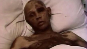 Penyakit radiasi akut, foto diambil di klinik khusus, Uni Soviet, setelah bencana Chernobyl pada 26 April 1986. Foto: HistoryDefined