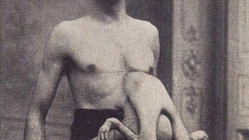 Jean Libbera, alias “The Double-Bodied Man,” memiliki saudara parasitnya, Jacques Libbera, yang terhubung dengannya dari area dada-perutnya. Foto: HistoryDefined