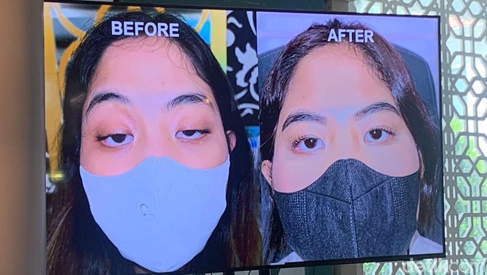 Kisahnya Viral di TikTok, Wanita Mata Ngantuk Buka-bukaan soal Kelainan Ptosis