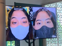 Apa Itu Ptosis? Berikut Penyebab, Gejala dan Pengobatan