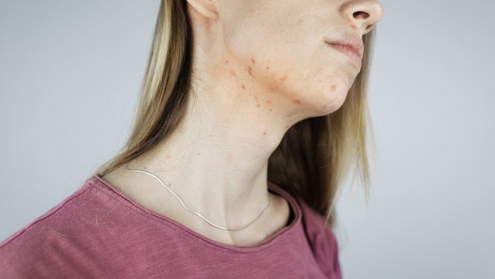 Penyebab jerawar di leher. Foto: Getty Images/Alona Siniehina