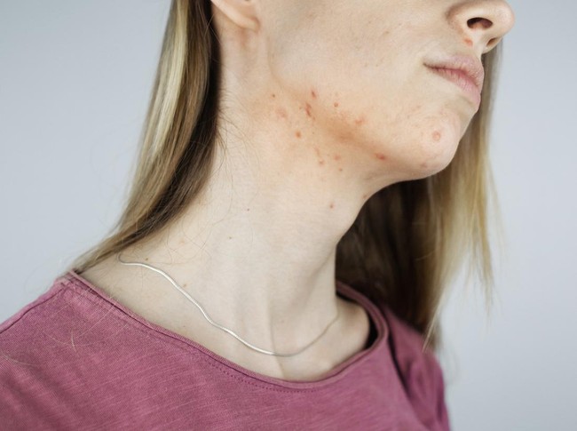 Penyebab Jerawat di Leher
