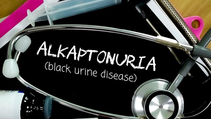 Alkaptonuria atau black urine disease
