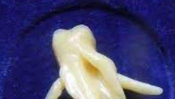 Ternyata, Ini Gigi Bungsu Seseorang Foto: Boredpanda