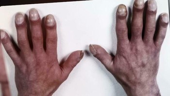 Tangan Pembunuh Berantai Jerman Fritz Honka Foto: Boredpanda