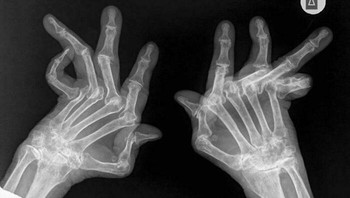 Seperti Inilah Gambaran Kondisi Radang Sendi Reumatoid Parah Foto: Boredpanda