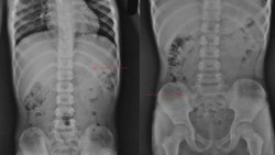 Horor, Penampakan X-Ray Bocah Telan Pensil yang Nyangkut di Perutnya