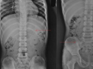 Horor, Penampakan X-Ray Bocah Telan Pensil yang Nyangkut di Perutnya