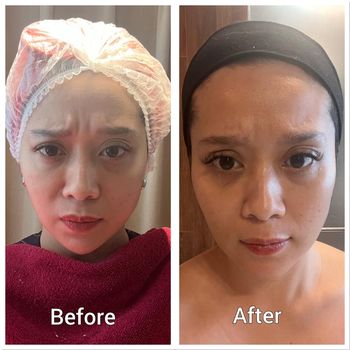 Review baby botox Review baby botox