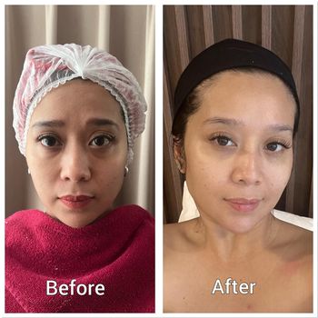 Review baby botox Review baby botox